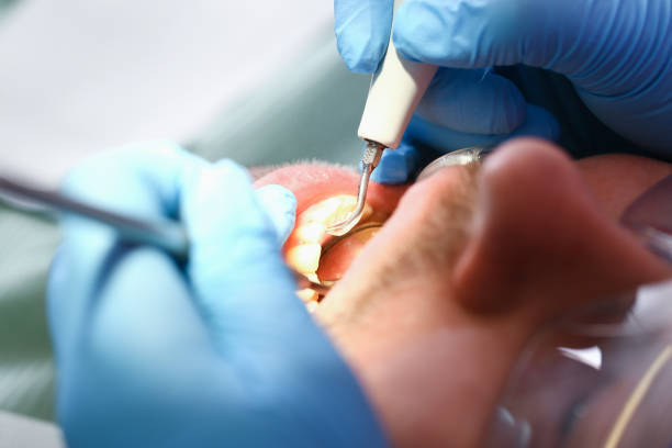 Best Emergency Treatment for Dental Infections or Abscesses in Jasmine Estates, FL