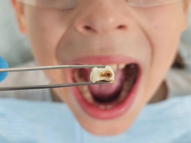 Best Emergency Dental Care for Broken or Chipped Teeth in Jasmine Estates, FL